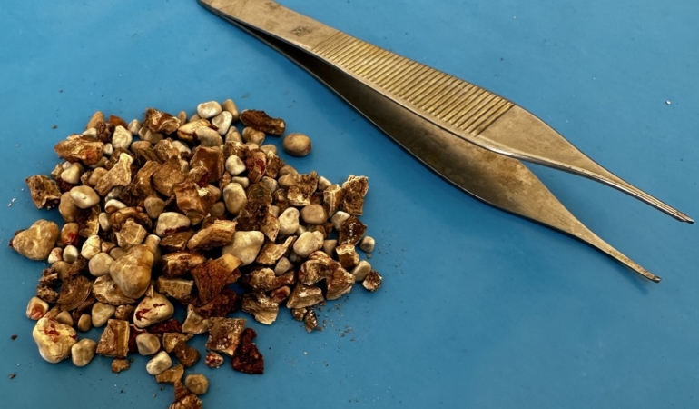 Böbreği şantiyeye dönmüş! 300’den fazla taş çıktı