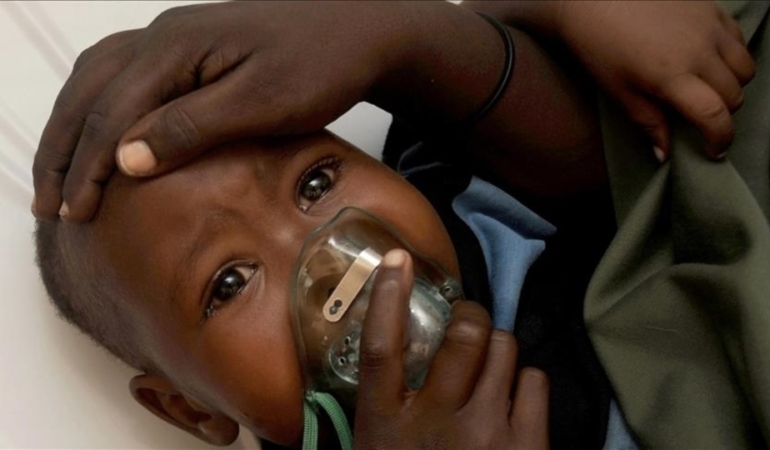 Gana’da M çiçeği olay sayısı 133’e yükseldi