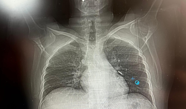 İmplant vidası ciğerine kaçtı! Hasta vefattan döndü