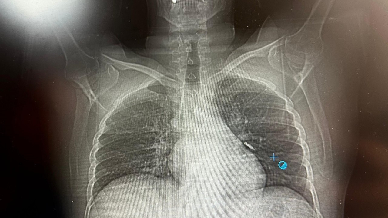 implant-vidasi-cigerine-kacti-hasta-vefattan-dondu-ja5kNqrb.jpg