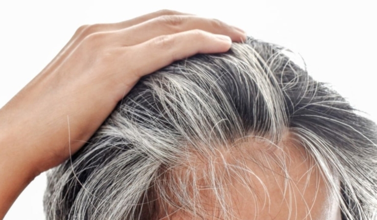 Saçları 14 yaşında beyazladı, araştırdı sebebini buldu