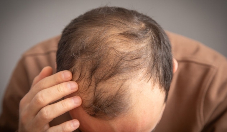 Erkeklerde kelliğe neden olan içecekler açıklandı